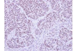 IHC-P Image Immunohistochemical analysis of paraffin-embedded SW480 xenograft , using FHL5, antibody at 1:500 dilution. (FHL5 antibody)