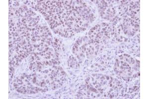 IHC-P Image Immunohistochemical analysis of paraffin-embedded SW480 xenograft , using FHL5, antibody at 1:500 dilution.