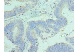 Immunohistochemistry of paraffin-embedded human colon cancer using ABIN7144450 at dilution of 1:100 (BCL2L14 antibody  (AA 1-327))
