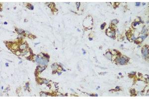 Immunohistochemistry of paraffin-embedded Human gastric cancer using ECH1 Polyclonal Antibody at dilution of 1:150 (40x lens). (ECH1 antibody)