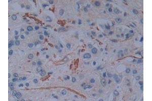Detection of PLS3 in Human Prostate cancer Tissue using Polyclonal Antibody to Plastin 3 (PLS3) (Plastin 3 antibody  (AA 379-630))