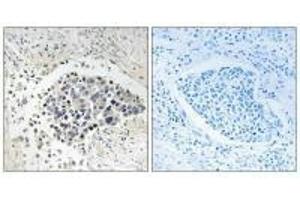 Immunohistochemistry analysis of paraffin-embedded human lung carcinoma tissue using CPNE8 antibody. (CPNE8 antibody  (N-Term))