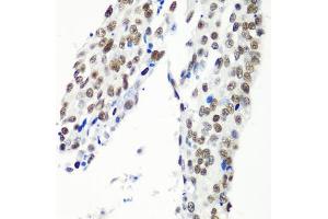 Immunohistochemistry of paraffin-embedded human lung cancer using HT antibody  at dilution of 1:100 (40x lens). (HTATSF1 antibody  (AA 1-270))
