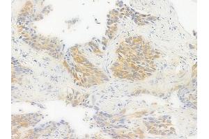 ABIN6256392 and ABIN6267376 at 1/100 staining human lung squamous cell carcinoma by IHC-P. (Glycogen Synthase antibody  (pSer645))
