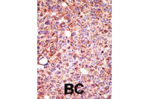 Formalin-fixed and paraffin-embedded human cancer tissue reacted with MGAT3 polyclonal antibody  , which was peroxidase-conjugated to the secondary antibody, followed by AEC staining . (MGAT3 antibody  (N-Term))