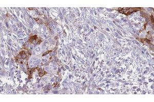ABIN6277553 at 1/100 staining Human urothelial cancer tissue by IHC-P. (CD42a antibody  (Internal Region))