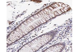 ABIN6267547 at 1/200 staining human colon cancer tissue sections by IHC-P.