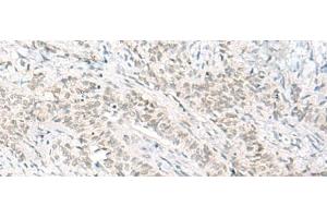 Immunohistochemistry of paraffin-embedded Human ovarian cancer tissue using HABP4 Polyclonal Antibody at dilution of 1:60(x200) (HABP4 antibody)