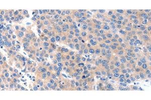 Immunohistochemistry of paraffin-embedded Human liver cancer tissue using KLK2 Polyclonal Antibody at dilution 1:100 (Kallikrein 2 antibody)
