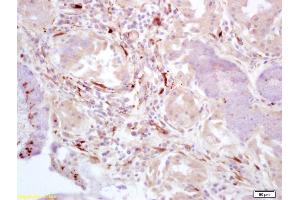 Formalin-fixed and paraffin embedded human lung carcinoma labeled with Rabbit Anti-FAK gamma Polyclonal Antibody (ABIN675189) at 1:200 followed by conjugation to the secondary antibody and DAB staining. (FAK antibody  (AA 901-1052))