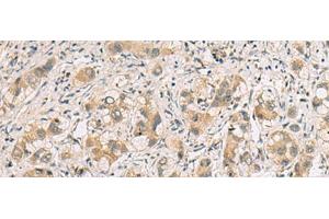 Immunohistochemistry of paraffin-embedded Human liver cancer tissue using RTP4 Polyclonal Antibody at dilution of 1:80(x200)