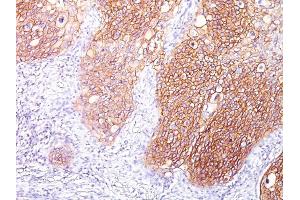 Formalin-fixed, paraffin-embedded human Lung SqCC stained with EGFR Mouse Monoclonal Antibody (GFR/1667). (EGFR antibody)
