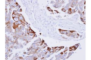 IHC-P Image Immunohistochemical analysis of paraffin-embedded H441 xenograft , using RAC1, antibody at 1:100 dilution. (RAC1 antibody  (Center))