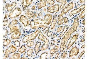 ABIN6257582 and ABIN6275689 at 1/100 staining Human kidney cancer and adjacent normal tissues by IHC-P. (ZFYVE19 antibody  (Internal Region))
