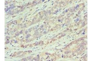 Immunohistochemistry of paraffin-embedded human endometrial cancer using ABIN7145167 at dilution of 1:100 (Cyclin D1 antibody  (AA 1-233))