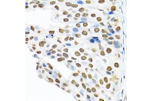 Immunohistochemistry of paraffin-embedded human prostate cancer using PTBP1 antibody (ABIN5995415) at dilution of 1/100 (40x lens). (PTBP1 antibody)