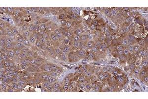 ABIN6273840 at 1/100 staining Human liver cancer tissue by IHC-P. (CCR1 antibody  (N-Term))