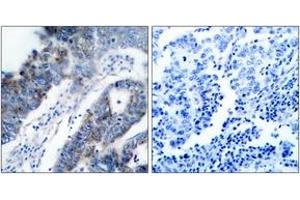Immunohistochemistry analysis of paraffin-embedded human breast carcinoma tissue, using ASK1 (Ab-83) Antibody. (ASK1 antibody  (AA 49-98))
