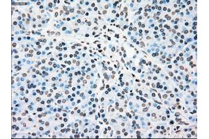 Immunohistochemical staining of paraffin-embedded Carcinoma of kidney tissue using anti-PLK1mouse monoclonal antibody. (PLK1 antibody)