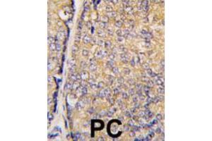 Formalin-fixed and paraffin-embedded human prostate carcinoma tissue reacted with STAP1 polyclonal antibody  , which was peroxidase-conjugated to the secondary antibody, followed by DAB staining. (STAP1 antibody  (Phe56))