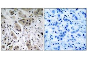 Immunohistochemical analysis of paraffin- embedded human breast carcinoma tissue, using Akt (phospho-Ser473) antibody (E011054). (AKT1 antibody  (pSer473))