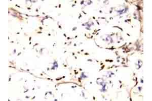 Immunohistochemical staining of IFITM1 on formalin fixed, paraffin embedded human intestines cancer tissue with IFITM1 polyclonal antibody . (IFITM1 antibody  (N-Term))
