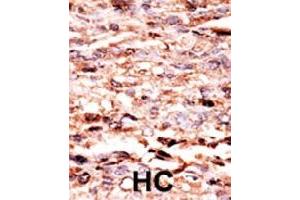 Formalin-fixed and paraffin-embedded human hepatocellular carcinoma tissue reacted with JUN (phospho S63) polyclonal antibody  which was peroxidase-conjugated to the secondary antibody followed by AEC staining.