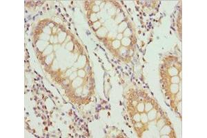Immunohistochemistry of paraffin-embedded human colon cancer using ABIN7163635 at dilution of 1:100 (PLEKHA1 antibody  (AA 285-404))