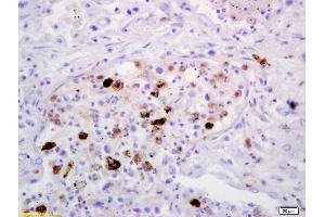 Formalin-fixed and paraffin embedded human lung carcinoma labeled with Anti-MRC1/CD206 Polyclonal Antibody, Unconjugated (ABIN1386219) at 1:200 followed by conjugation to the secondary antibody and DAB staining (Macrophage Mannose Receptor 1 antibody  (AA 201-300))