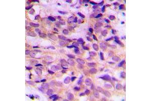 Immunohistochemical analysis of ATG4B staining in human breast cancer formalin fixed paraffin embedded tissue section. (ATG4B antibody  (Center))