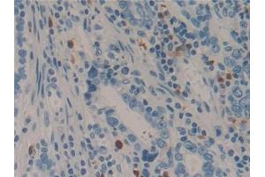 Detection of LAMC2 in Human Stomach cancer Tissue using Polyclonal Antibody to Laminin Gamma 2 (LAMC2)