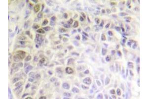 Immunohistochemistry analyzes of Ku70 antibody in paraffin-embedded human liver carcinoma tissue. (XRCC6 antibody)