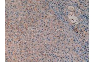 IHC-P analysis of Human Liver Cancer Tissue, with DAB staining. (Hemoglobin Subunit beta antibody  (AA 1-147))
