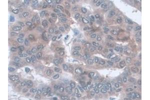 Detection of AST in Human Liver cancer Tissue using Monoclonal Antibody to Aspartate Aminotransferase (AST)