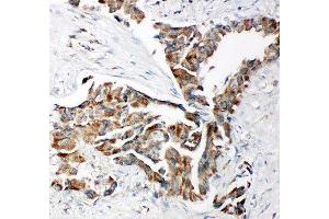 IHC-P: TRAM antibody testing of human lung cancer tissue (TICAM2 antibody  (C-Term))