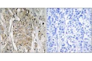 Immunohistochemistry analysis of paraffin-embedded human breast carcinoma tissue, using HER2 Antibody.