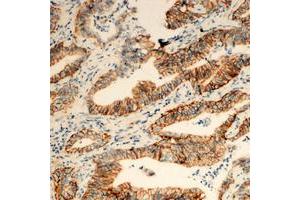 Immunohistochemical analysis of TUSC3 staining in human colon cancer formalin fixed paraffin embedded tissue section. (TUSC3 antibody  (Center))