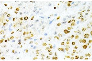 Immunohistochemistry of paraffin-embedded Human liver cancer using DKC1 Polyclonal Antibody at dilution of 1:200 (40x lens). (DKC1 antibody)