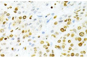 Immunohistochemistry of paraffin-embedded Human liver cancer using DKC1 Polyclonal Antibody at dilution of 1:200 (40x lens). (DKC1 antibody)
