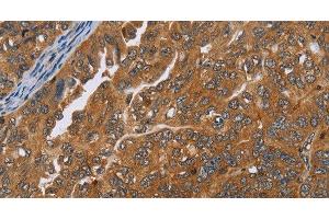 Immunohistochemistry of paraffin-embedded Human ovarian cancer tissue using ADAMTS15 Polyclonal Antibody at dilution 1:40