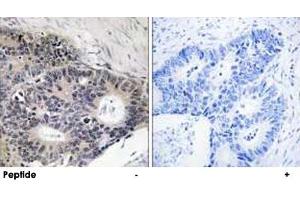 Immunohistochemistry analysis of paraffin-embedded human colon carcinoma tissue using ABHD12B polyclonal antibody .