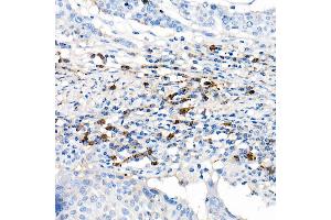 Immunohistochemistry of paraffin-embedded human cervix cancer using Lambda Light chain Rabbit mAb (ABIN7267847) at dilution of 1:100 (40x lens). (IGLV1-51 antibody)