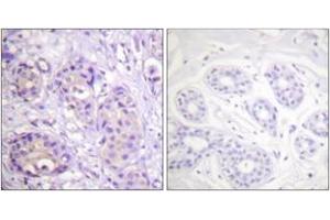 Immunohistochemistry analysis of paraffin-embedded human breast carcinoma, using IKK-beta (Phospho-Tyr199) Antibody. (IKBKB antibody  (pTyr199))