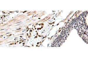 Immunohistochemistry of paraffin-embedded Human gastric cancer tissue using ARHGDIB Polyclonal Antibody at dilution of 1:35(x200) (ARHGDIB antibody)