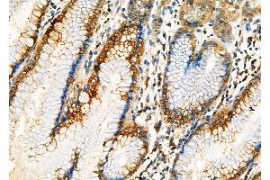 ABIN6262636 and ABIN6276998 at 1/100 staining Human gastric cancer and adjacent normal tissues by IHC-P. (Importin 5 antibody  (Internal Region))