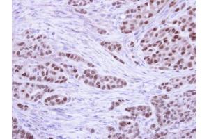 IHC-P Image Immunohistochemical analysis of paraffin-embedded A549 Xenograft, using RPA 32 kDa subunit , antibody at 1:100 dilution. (RPA2 antibody)