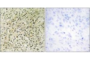 Immunohistochemistry analysis of paraffin-embedded human prostate carcinoma tissue, using RHG07 Antibody. (DLC1 antibody  (AA 61-110))