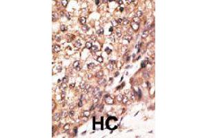 Formalin-fixed and paraffin-embedded human hepatocellular carcinoma tissue reacted with BMP7 polyclonal antibody  , which was peroxidase-conjugated to the secondary antibody, followed by DAB staining. (BMP7 antibody  (N-Term))