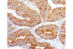 IHC testing of FFPE human colon carcinoma with TL1A antibody (clone TLRM1-1).