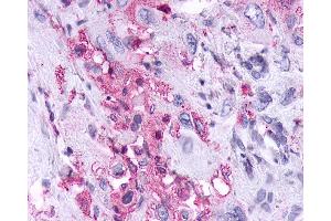 Anti-KISS1R / GPR54 antibody IHC of human Pancreas, Carcinoma. (KISS1R antibody  (Cytoplasmic Domain))